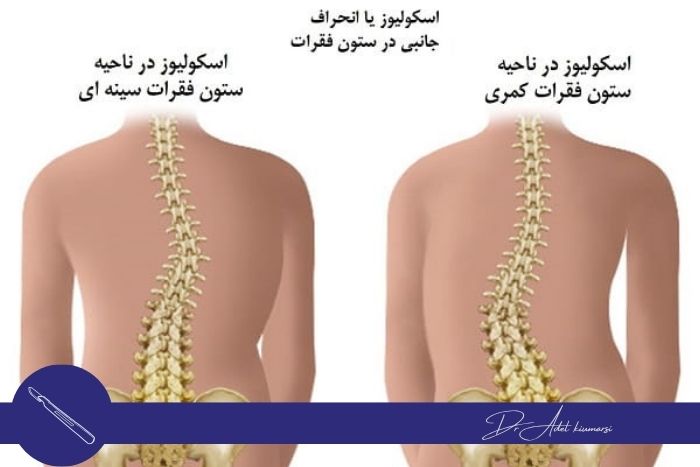 انواع انحراف ستون فقرات انواع انحراف ستون فقرات