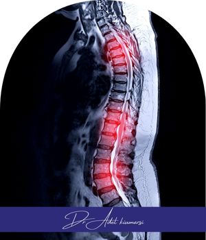 علائم تنگی کانال نخاعی