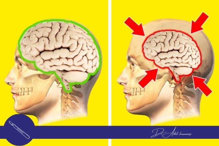 آتروفی مغزی چیست؟