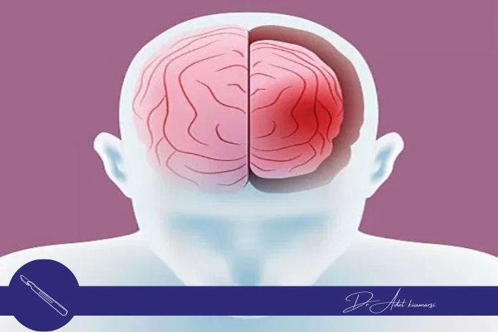 آیا آتروفی مغزی قابل درمان است؟