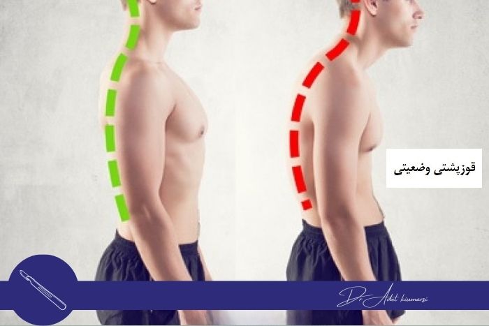 آیا جراحی می‌تواند بیماری کیفوز را درمان کند؟