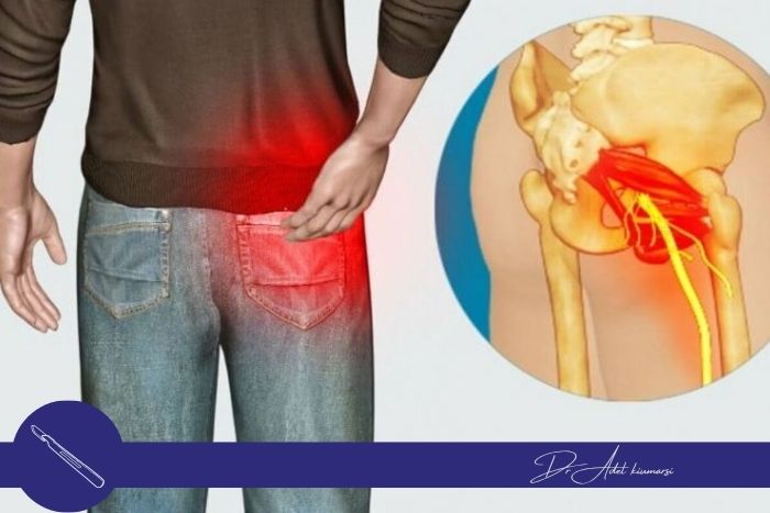 آیا امکان مزمن شدن درد سیاتیک وجود دارد؟