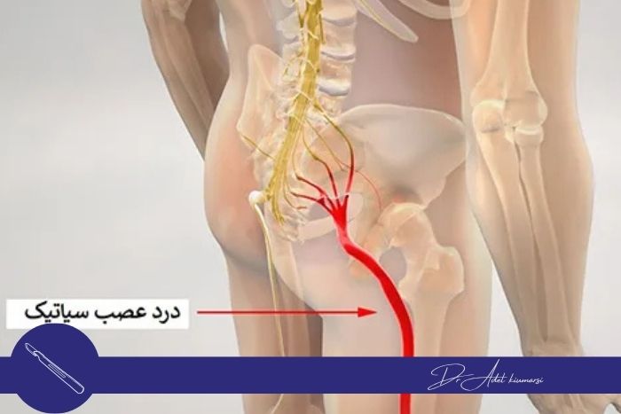 روش‌های تشخیص بیرون زدگی دیسک کمر