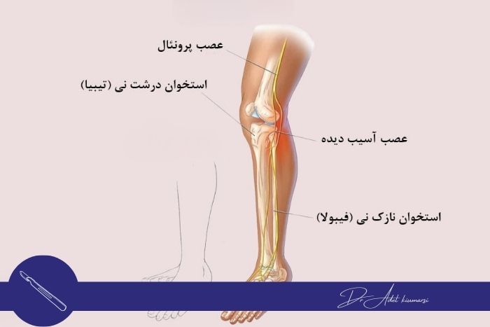 انواع آسیب‌های عصبی و تأثیر آن‌ها بر بهبودی