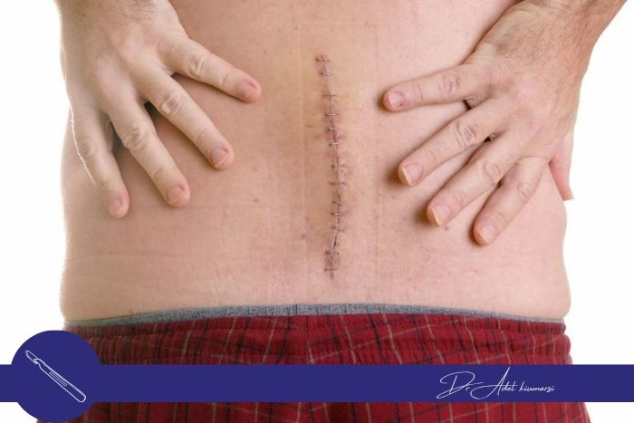 خطرات و عوارض جراحی دیسک کمر