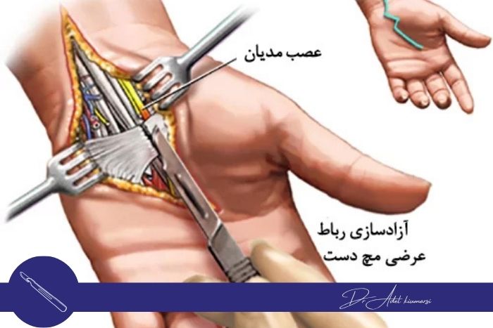 درمان‌های اختصاصی بر اساس محل درگیری عصب