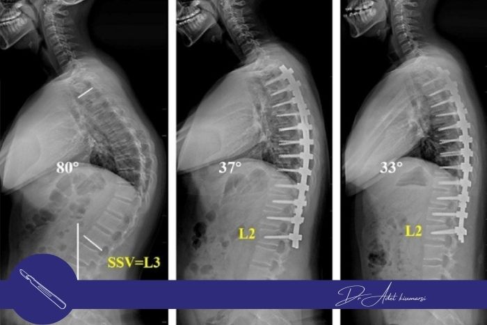 چه زمانی عمل انحراف ستون فقرات ضروری است؟
